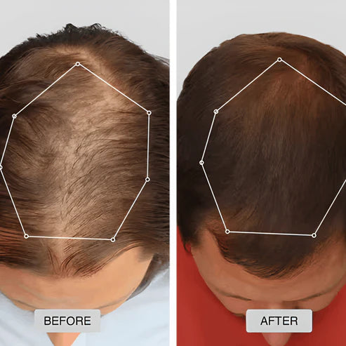 Red Light Therapy Cap for Hair Regrowth by Home Of Tech Essentials, showing before and after results on scalp with hair growth.