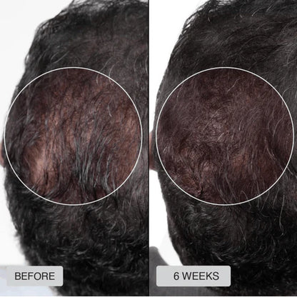 Red Light Therapy Cap for hair regrowth by Home Of Tech Essentials, showing before and after results on scalp hair growth.